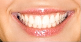 woman's mouth smiling, nice white teeth dental bonding Gardnerville, NV